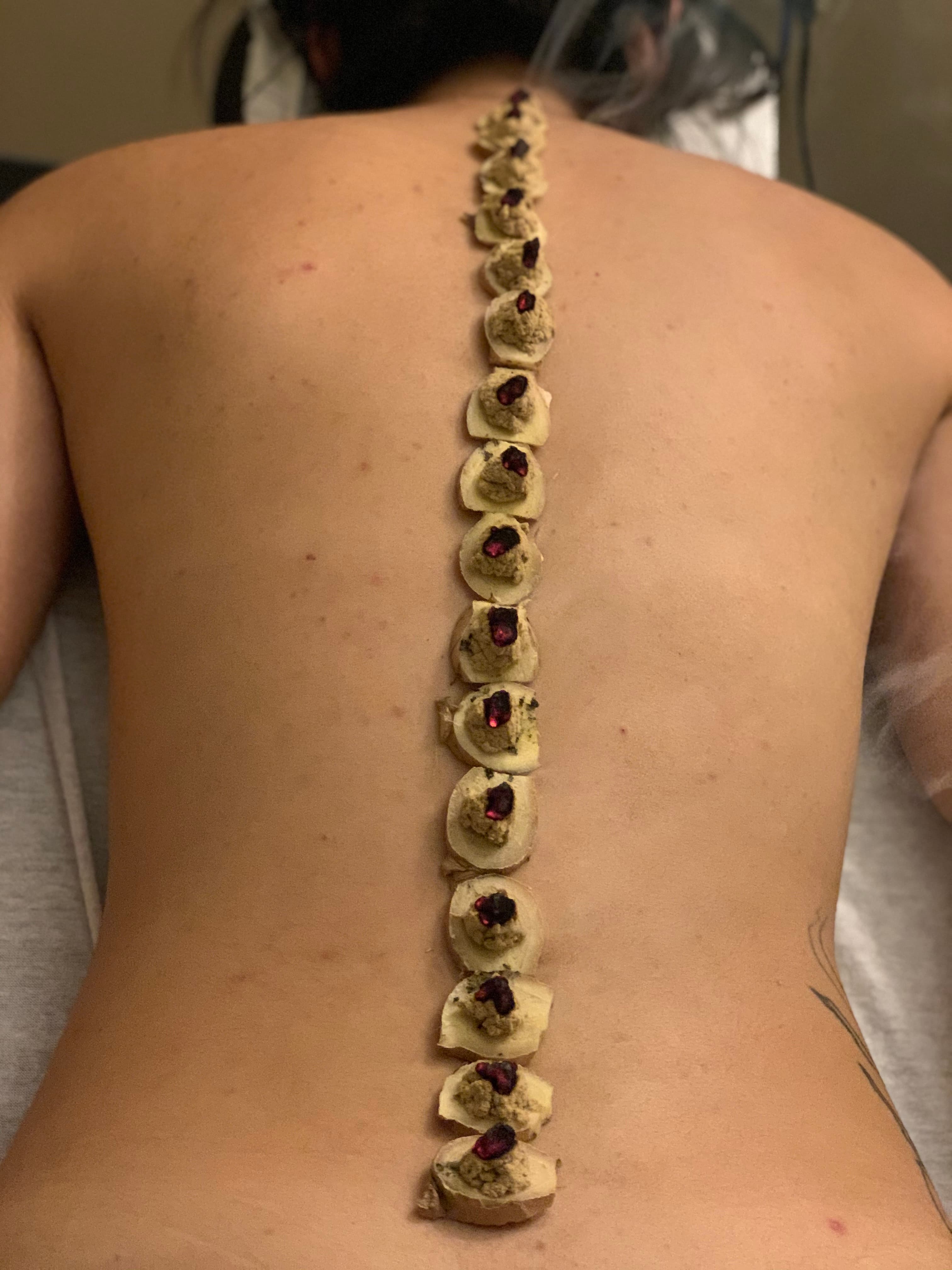 Moxibustion treatment along the spine — a warming technique used in Chinese medicine for fertility support